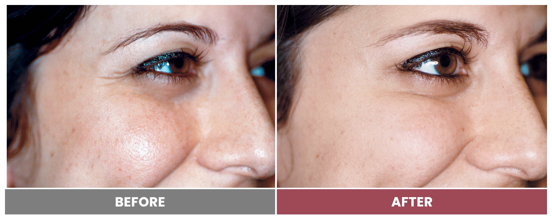 LASER SKIN RESURFACING - Case 7
